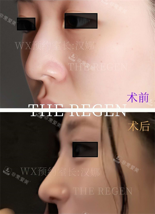 韓國(guó)JN整形鼻綜合手術(shù)前后對(duì)比圖 韓國(guó)JN整形鼻綜合手術(shù)前后對(duì)比圖