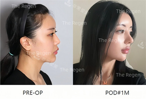 韩国德丽珍整形外科自体耳软骨隆鼻前后对比图