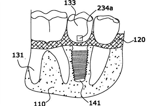 种植牙结构图