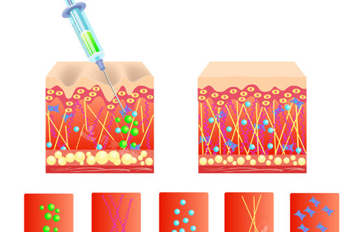 注射玻尿酸前后皮肤深层次的变化