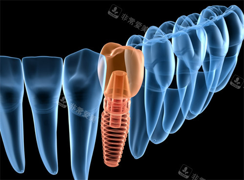 种植牙动画图示