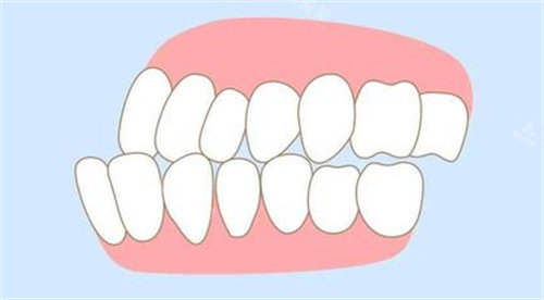 牙齒畸形動(dòng)畫(huà)圖