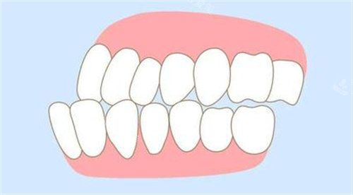 牙齒畸形動(dòng)畫圖