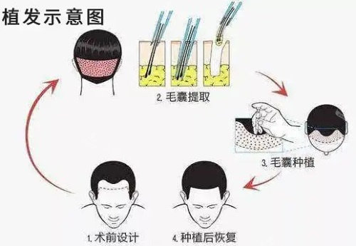 植發(fā)過程圖 植發(fā)過程圖