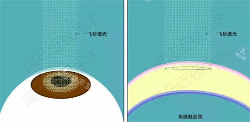 飞秒激光手术操作动画图