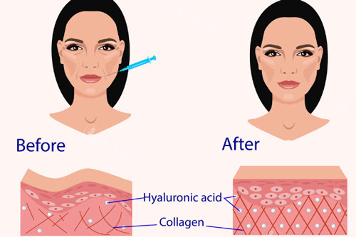 注射玻尿酸后皮肤的变化图解