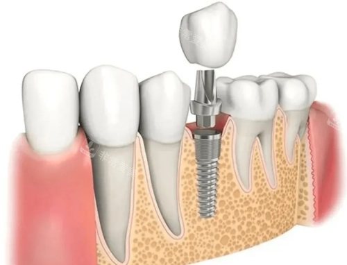 种植牙示意图