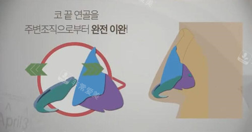 韩国431整形高难度鼻修复方案
