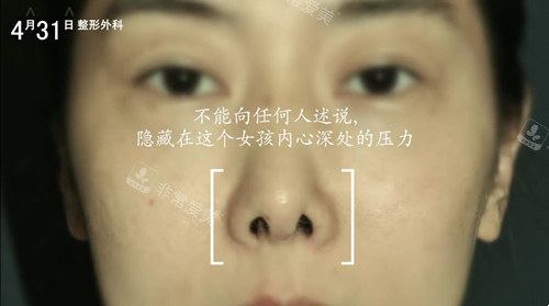 韩国431鼻修复模特背后故事：经历了7次修复的挛缩鼻正常了