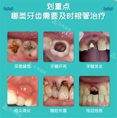 需要做根管治疗的情况