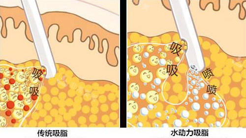 传统吸脂和水动力吸脂对比图