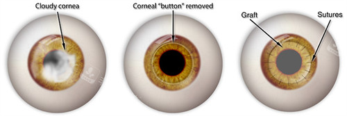 角膜移植手术动画图