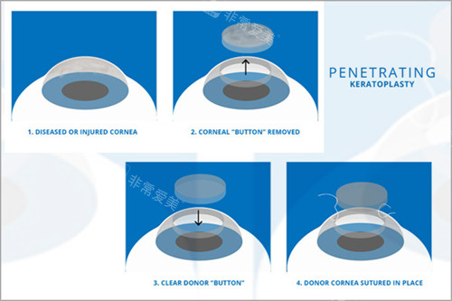 角膜移植手术过程演示图