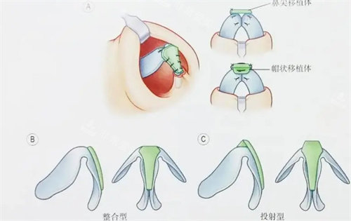 隆鼻结构展示图