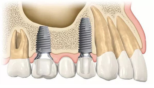 种植牙动画图