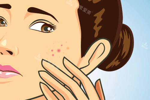 被皮肤问题困扰的女生