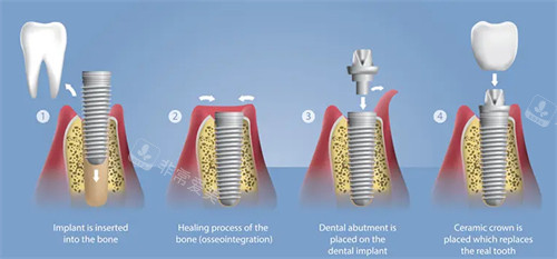 种植牙具体过程