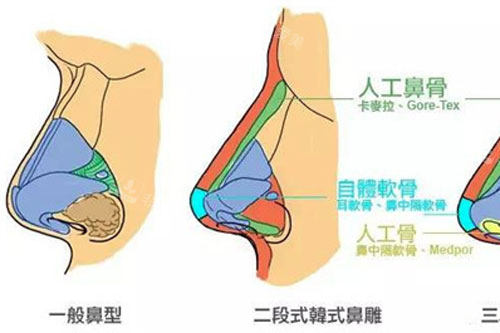 鼻整形