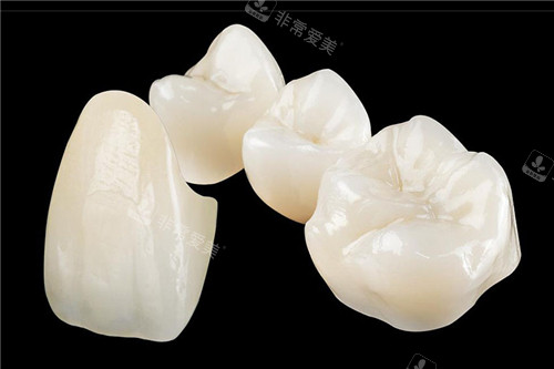 全瓷牙冠圖 全瓷牙冠圖