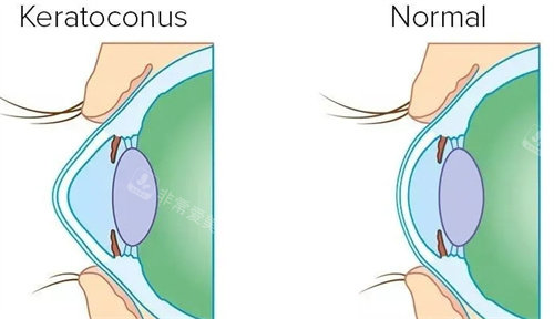 圆锥角膜交联术治疗前后对比图