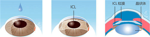 晶体植入手术步骤图