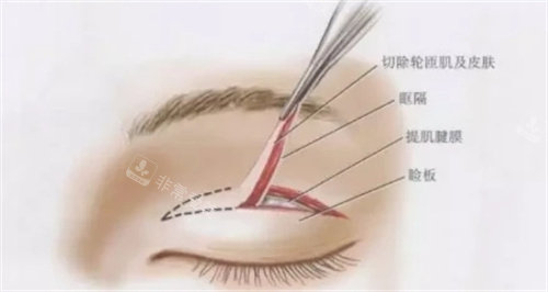 双眼皮切开动画图