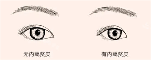 有無內(nèi)眥贅皮動畫圖 有無內(nèi)眥贅皮動畫圖