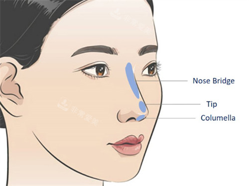 鼻部填充物需要取出的位置图解