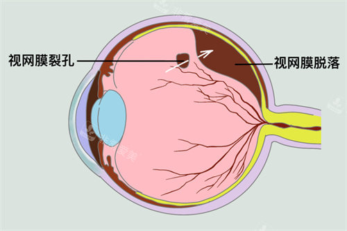 视网膜脱落示意图