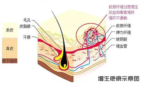 疤痕增生示意图