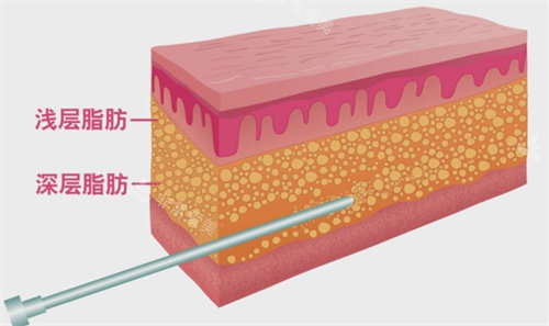 浅层吸脂与深层吸脂动画图