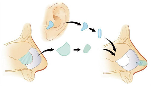 耳软骨隆鼻动画图