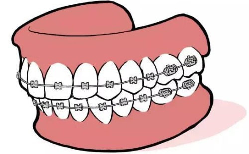 金属固定牙套示意图