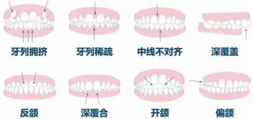 各种牙齿畸形示意图