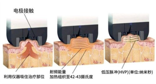 inmode钻石超塑