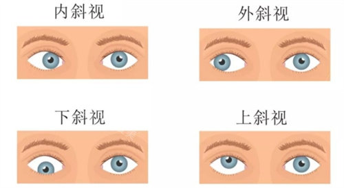 斜视的四种情况