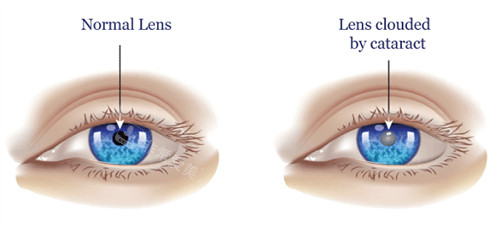 正常眼睛和白内障眼镜外观不同