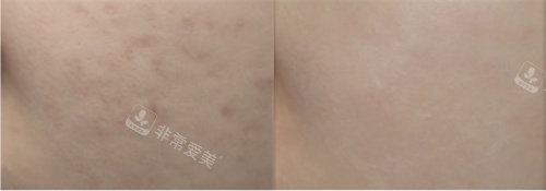 韓國露潭韓醫(yī)院去痘印 韓國露潭韓醫(yī)院去痘印