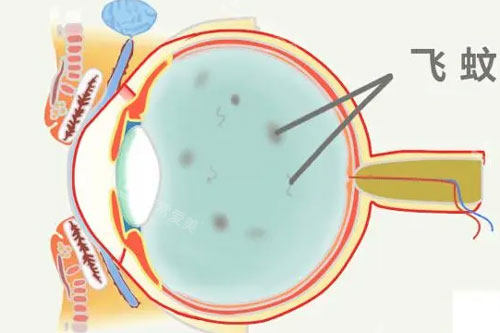 飞蚊症