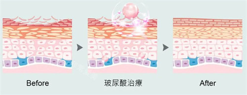 玻尿酸注射前后 玻尿酸注射前后