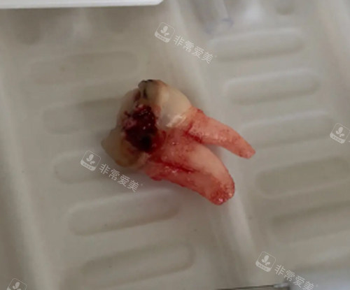 拔掉的牙齒照片