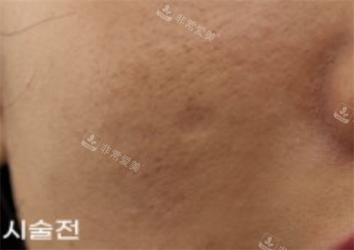 韩国露潭韩医院祛疤手术前图片