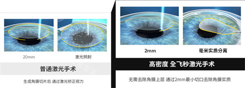 韓國KEYE愷熠眼科手術方式