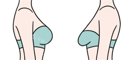 乳房下垂