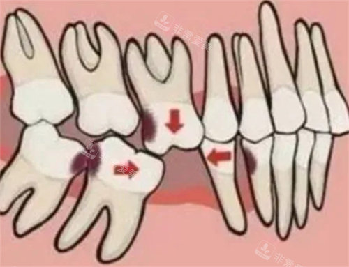 牙齿动画模拟图