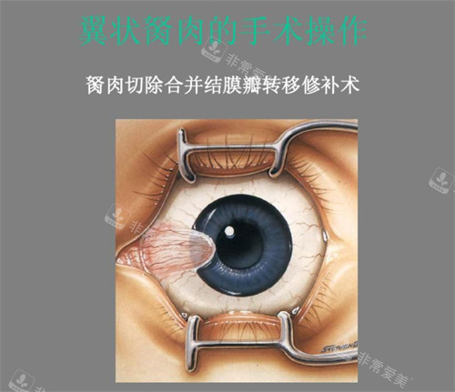 胬肉手术图示