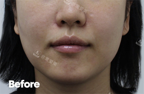 韩国Reyou皮肤科做超声提升前图片