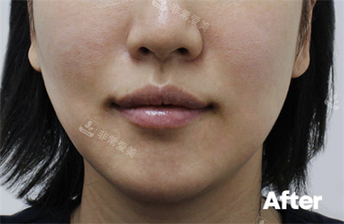 韩国Reyou皮肤科做超声提升前图片韩国Reyou皮肤科做超声提升后图片
