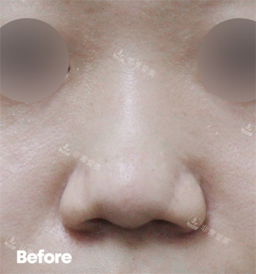 韩国Reyou皮肤科玻尿酸隆鼻术前图片