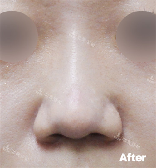 韩国Reyou皮肤科玻尿酸隆鼻术后图片